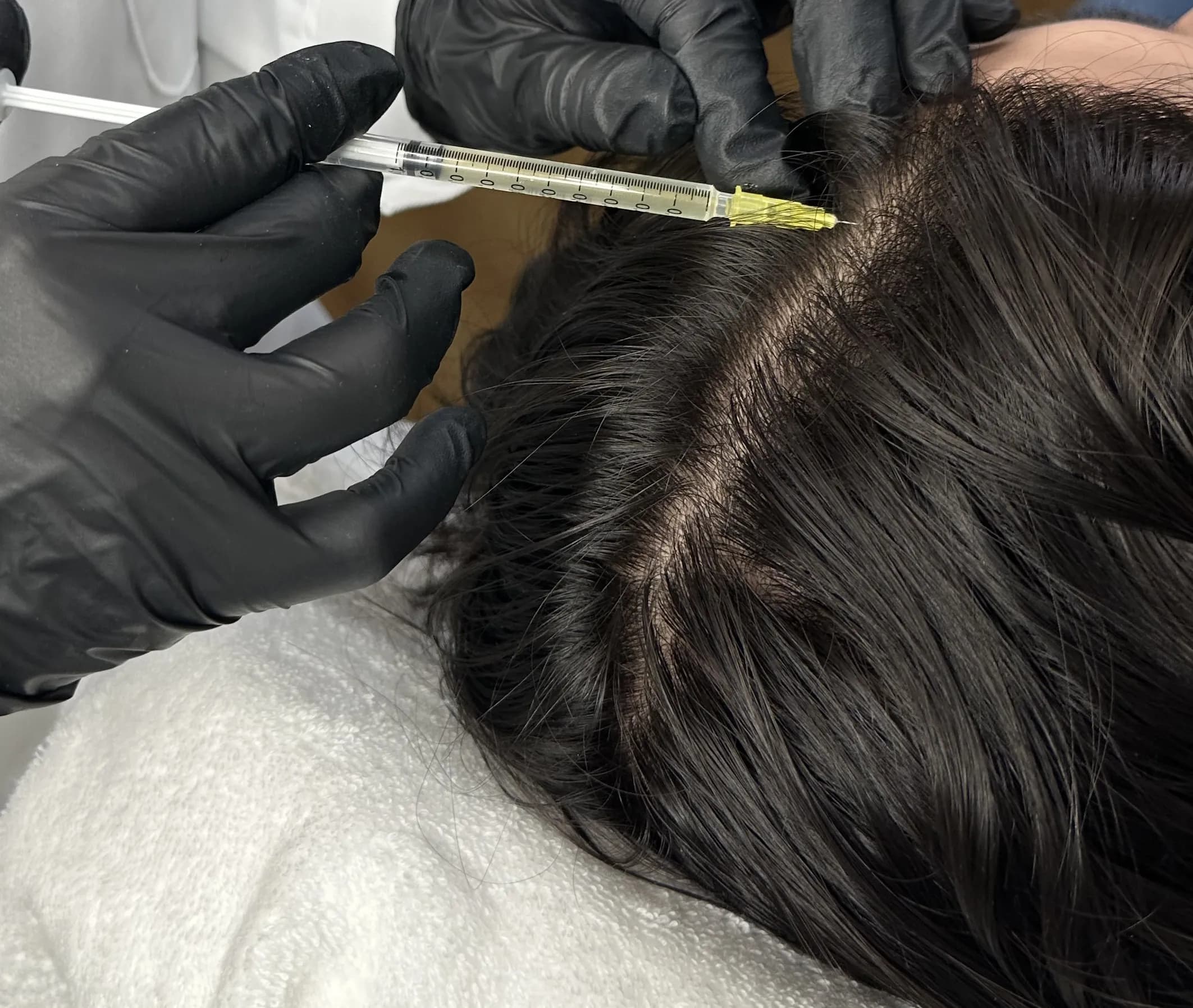 Mann mit Haarausfall Bild